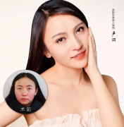 貴陽激光美白能維持多久？