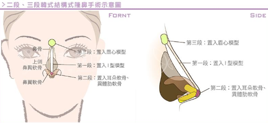 沈陽自體組織隆鼻那個(gè)效果比較好
