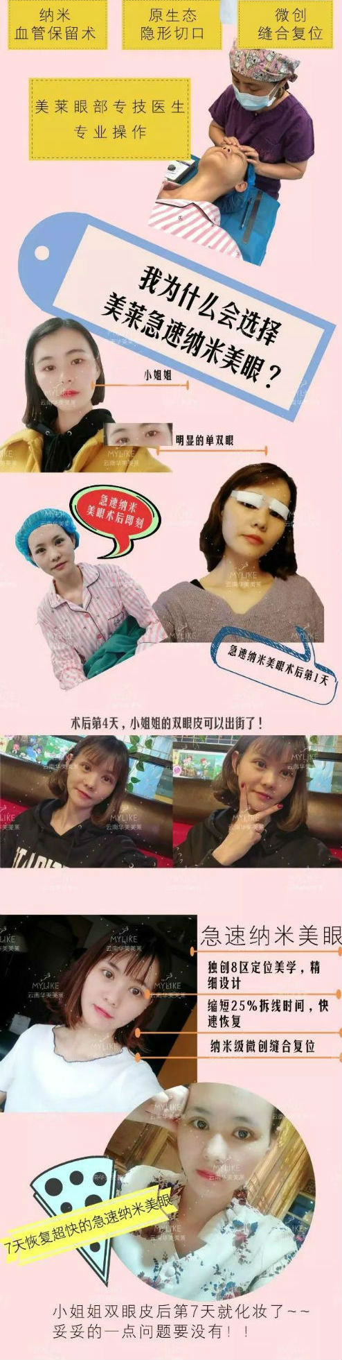7天的雙眼皮，又要幾天能恢復(fù)到自然？