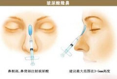 南京玻尿酸隆鼻多少錢一支？彌補(bǔ)美麗缺失