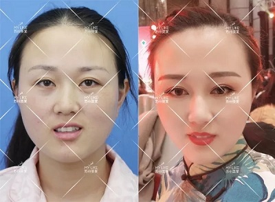 有些眼睛雙眼皮拯救不了，就來(lái)蘇州美萊做眼綜合手術(shù)！