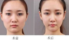重慶面部吸脂能快速瘦臉嗎？