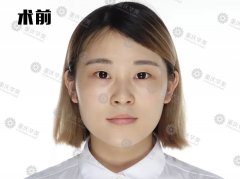 重慶華美雙眼皮大挑戰(zhàn)，術(shù)后半個月到底能不能被發(fā)現(xiàn)是割的？