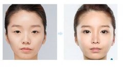 天津做上瞼下垂矯正的價(jià)格是多少？