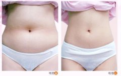 武漢適合做吸脂減肥手術(shù)的年齡段是多少？