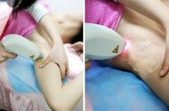 激光脫毛術(shù)后怎么護(hù)理？