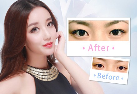 做個(gè)雙眼皮的價(jià)格要多少錢？