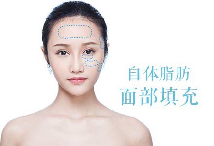 面部填充材料有哪些？