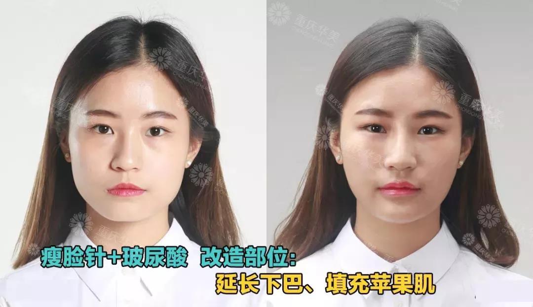 玻尿酸+瘦臉針這樣用，方臉、圓臉都可以變先進(jìn)小V臉
