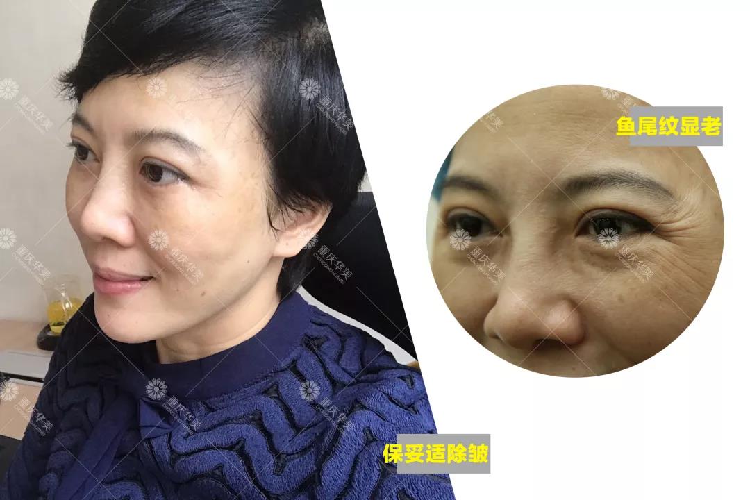 如果你是這種臉型，打瘦臉針一定有用！