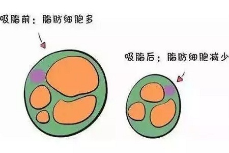 關(guān)于吸脂那些不能說的秘密，今天要在這里一次說完！
