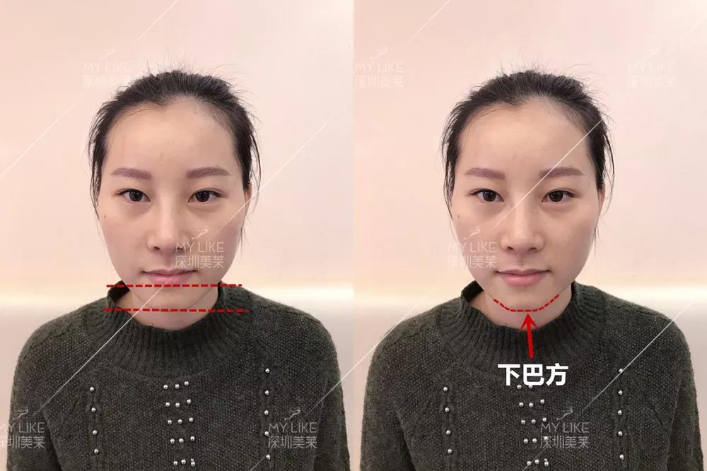 【真人案例】玻尿酸讓她！靜悄悄的變成少女臉