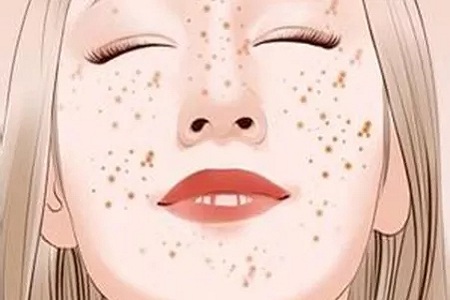 問診室：祛斑不難，找對病因才是重點，祛斑全面科普看過來