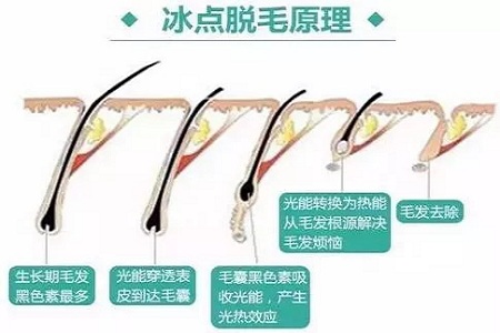 既便宜又安全的脫毛方法是什么？