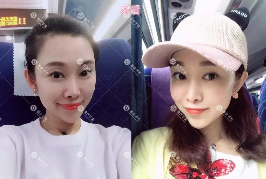 路人臉變上鏡臉，玻尿酸打一次真的會變美