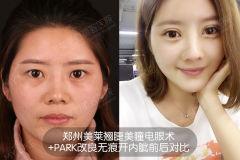 雙眼皮全切好還是埋線好？鄭州美萊割雙眼皮哪位醫(yī)生好？