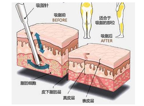 鄭州美萊吸脂瘦身等于減重？