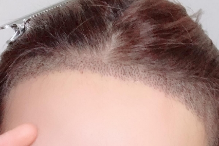 常州發(fā)際線調(diào)整效果好嗎，發(fā)際線如何調(diào)整？