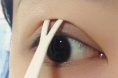 雙眼皮手術(shù)方法有幾種，術(shù)后注意事項(xiàng)有哪些