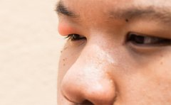 天生腫眼泡抽脂會反彈嗎，南京、杭州、上海眼皮抽脂費用表