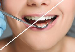 福州做冷光美白牙齒價(jià)格多少錢，一次可以維持多久